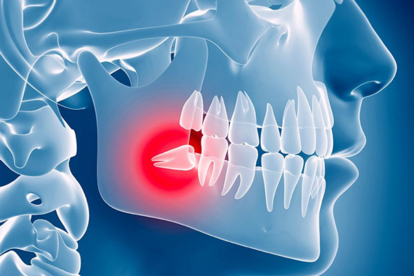 Chirurgie dents de sagesse Chirurgie dents de sagesse